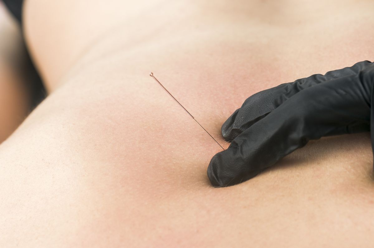 Dry needling, closeup of a physiotherapist with a needle and black gloves.